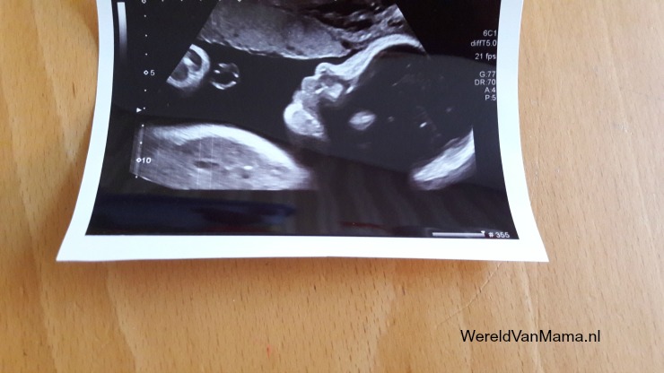 31-weken-zwanger-echo